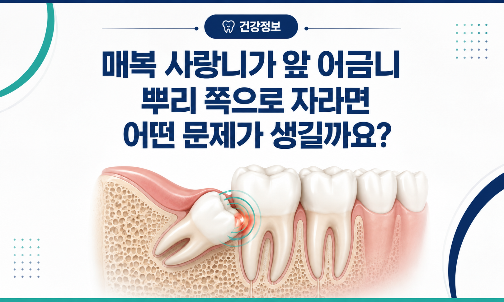 매복 사랑니가 앞 어금니 뿌리와 맞닿아 있는 모습