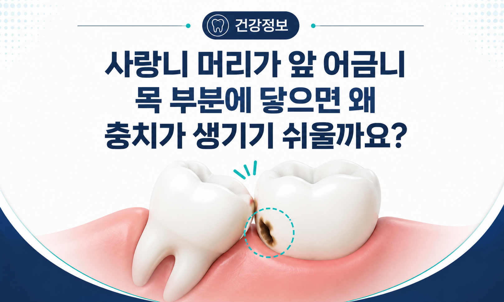 누운 사랑니와 앞 어금니 뒤쪽 충치가 생기는 위치