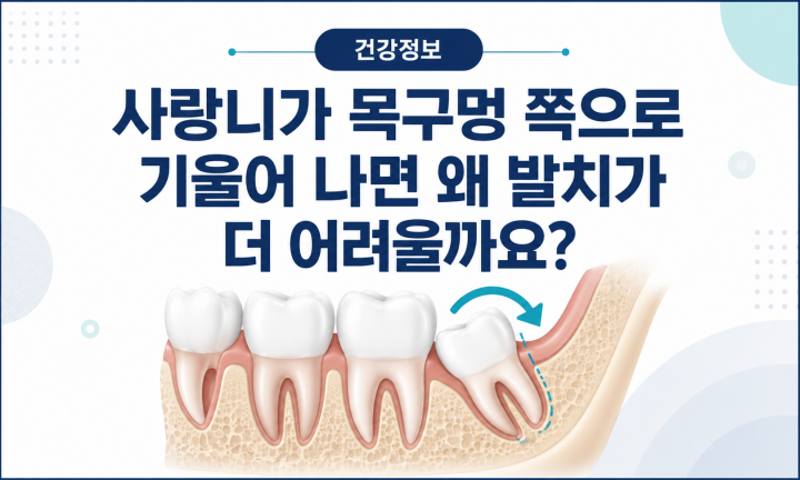 목구멍 방향으로 기울어진 아래 매복사랑니 위치