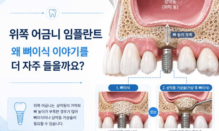 위쪽 어금니 임플란트와 상악동 및 잇몸뼈 위치를 설명하는 이미지