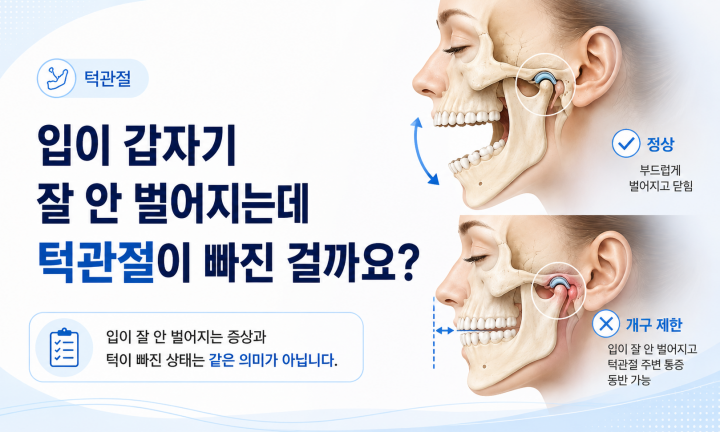 입이 잘 벌어지지 않는 턱관절 잠김과 턱관절 탈구의 차이를 설명하는 이미지
