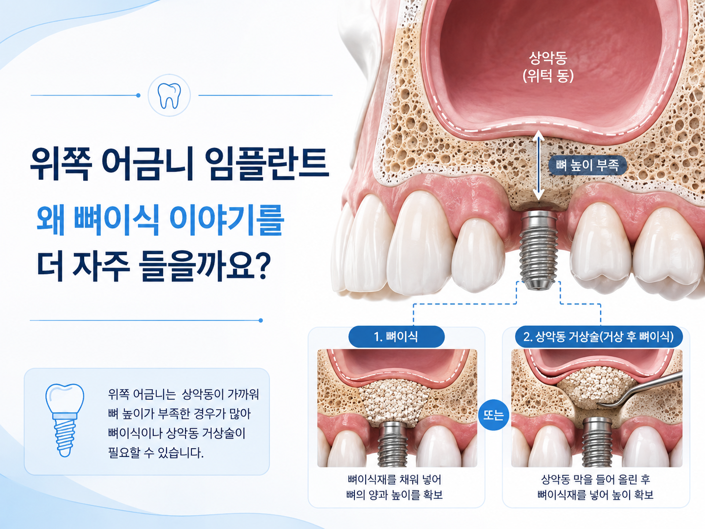 위쪽 어금니 임플란트와 상악동 및 잇몸뼈 위치를 설명하는 이미지