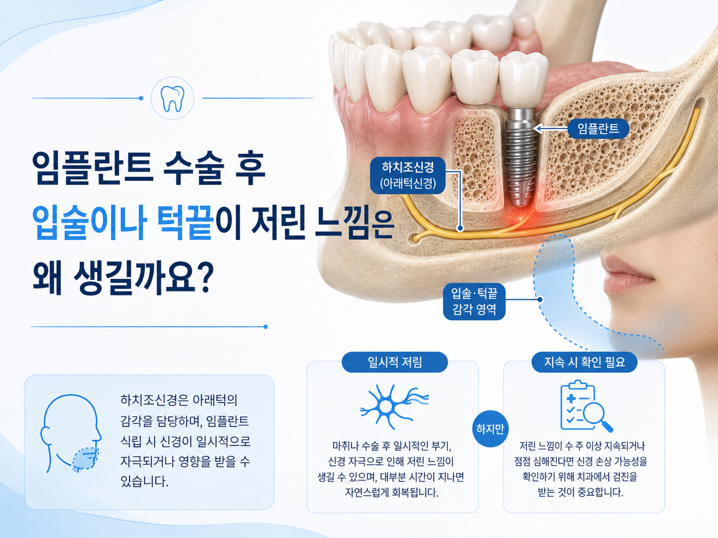 아래턱 임플란트와 하치조신경 및 턱끝 감각신경의 위치를 설명하는 이미지